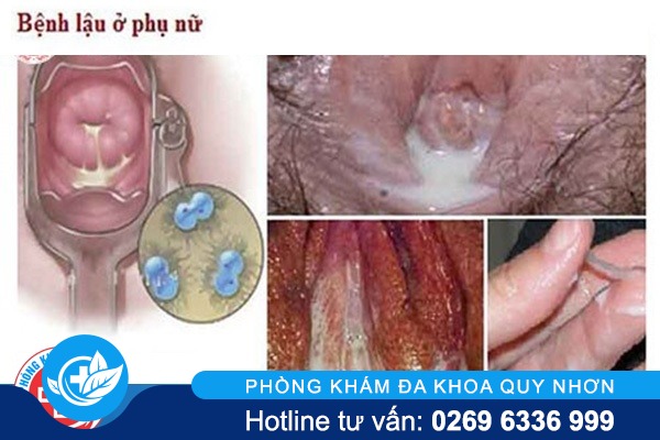 Âm đạo chảy mủ do lậu