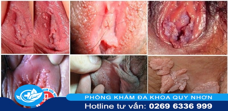 xung quanh âm đạo bị nổi mụn