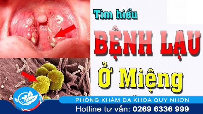 Các dấu hiệu điển hình khi mắc bệnh lậu ở miệng