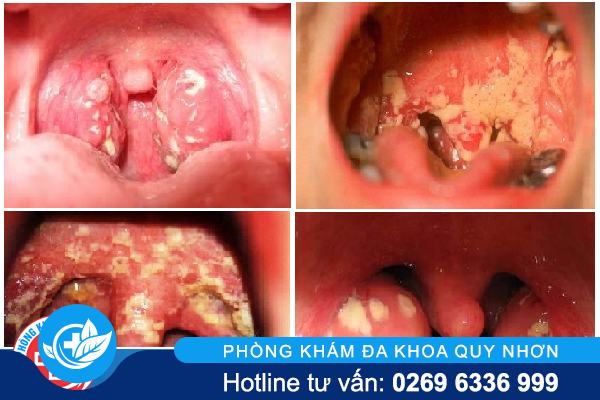 bệnh lậu ở miệng