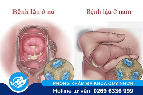 bệnh lậu ở nam và nữ