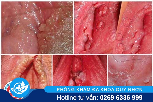 bieu-hien-cua-benh-sui-mao-ga-o-nu-gioi