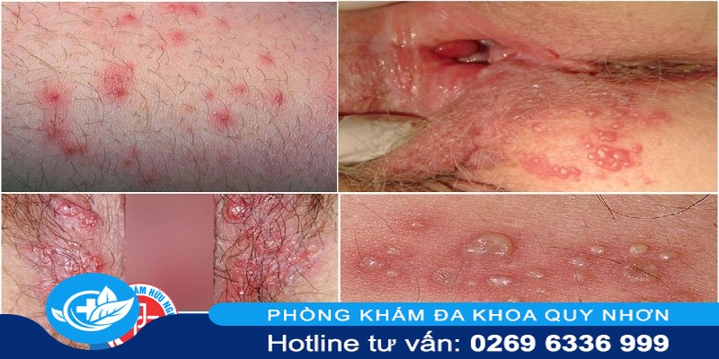 nhận biết mụn rộp sinh dục