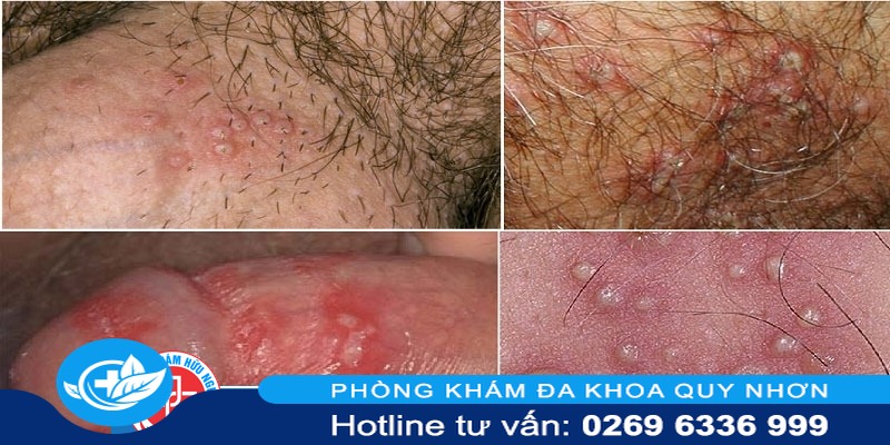 nhận biết mụn rộp sinh dục