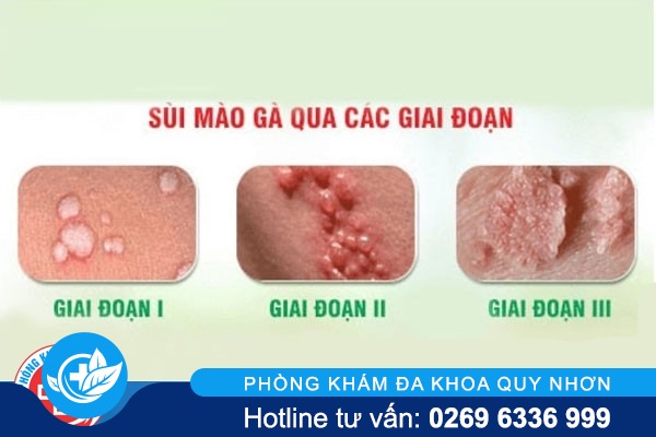 Cách nhận biết khi bị nhiễm virus HPV