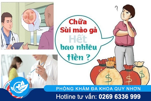 Chi phí hỗ trợ chữa sùi mào gà bao nhiêu?