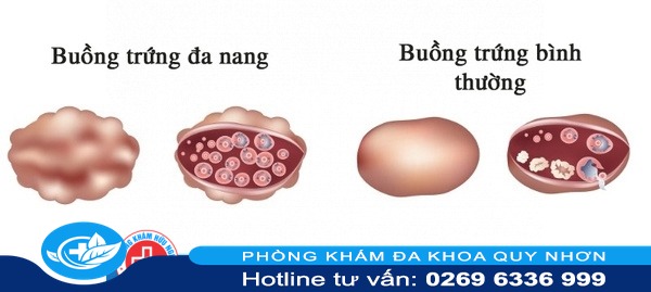 dấu hiệu nhận biết bệnh đa nang buồng trứng