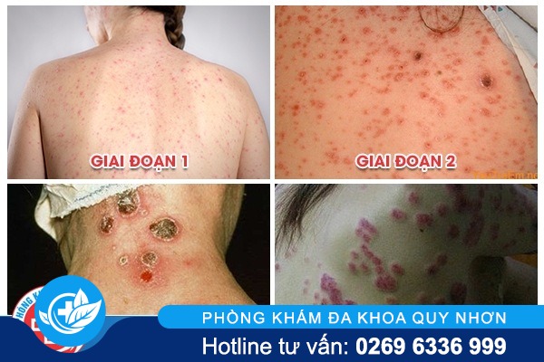 dia-chi-chua-benh-giang-mai-an-toan-o-nghe-an-1