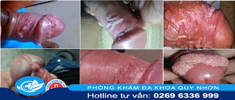 hinh anh sui mao ga o duong vat