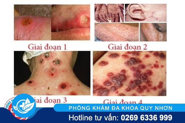 giang-mai-giai-doan-cuoi