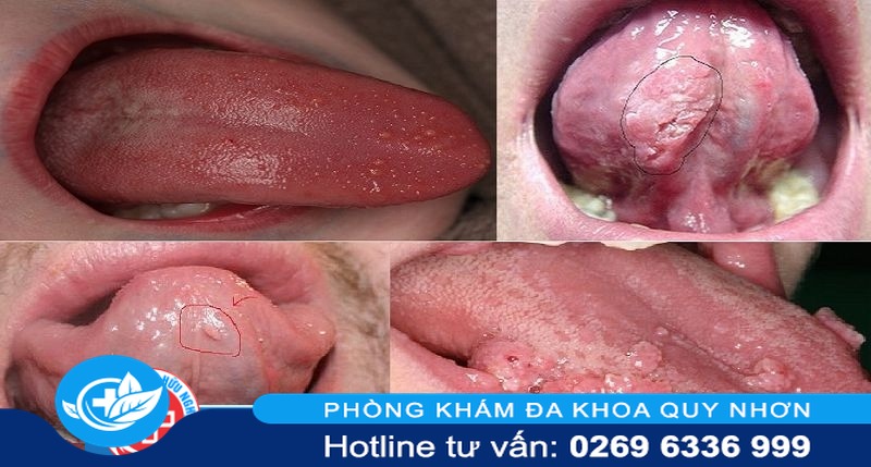 sùi mào gà ở lưỡi