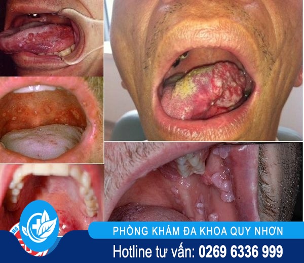 bệnh sùi mào gà ở lưỡi