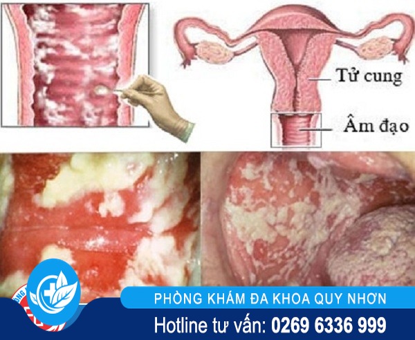 huyết trắng màu xanh lá cây