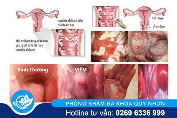 huyet-trang-co-mui-hoi-phai-lam-sao01