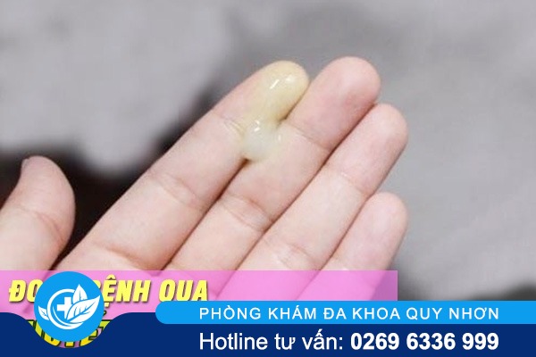 Huyết trắng màu vàng là bị bệnh gì?