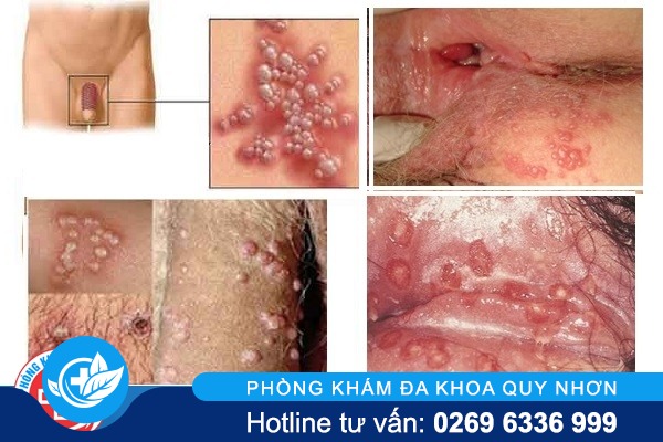 mun-rop-sinh-duc-nam-hieu-qua