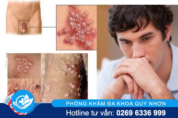 mun-rop-sinh-duc-nam-hieu-qua