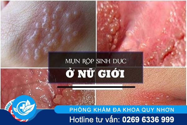 mun-rop-sinh-duc-nu-dau-hieu