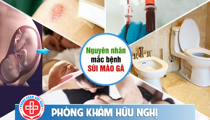 Mụn ở đầu dương vật nhưng không đau không ngứa có phải sùi mào gà?