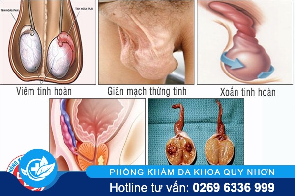 nhung-can-benh-co-trieu-chung-dau-tinh-hoan-phai-6