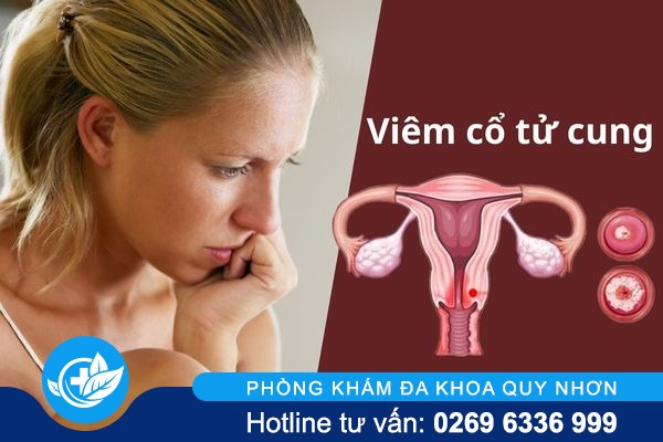 Những điều cần biết về bệnh viêm cổ tử cung