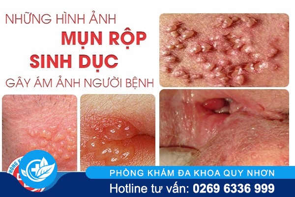 nhung-hinh-anh-mun-rop-sinh-duc-gay-am-anh-nguoi-benh