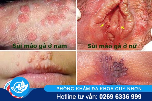 ob-d76c5a-benh-sui-mao-ga-la-gi