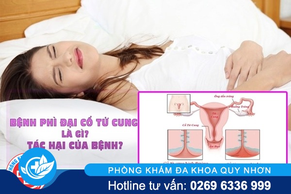 phì đại cổ tử cung