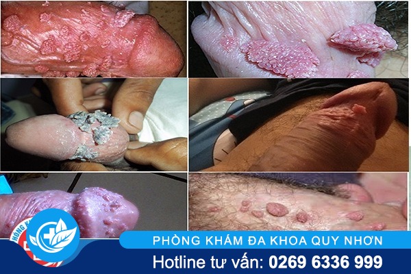 sui-mao-ga-duong-vat