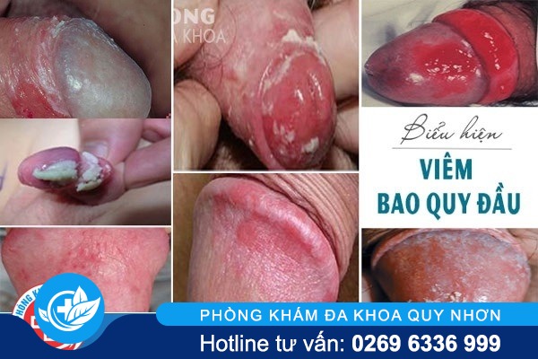 tac-hai-benh-viem-bao-quy-dau