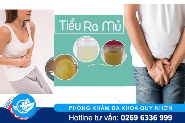 Bị tiểu ra mủ: dấu hiệu của nhiều bệnh nguy hiểm ở nam nữ giới