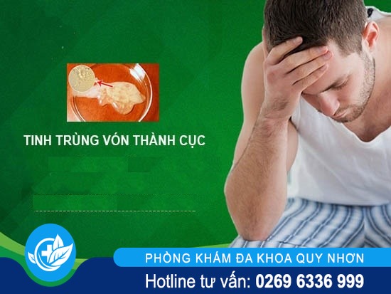 Tinh trùng vón cục ở nam giới là như thế nào ?