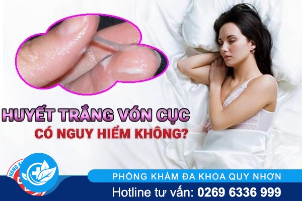 Mối nguy hiểm khó lường khi huyết trắng vón cục