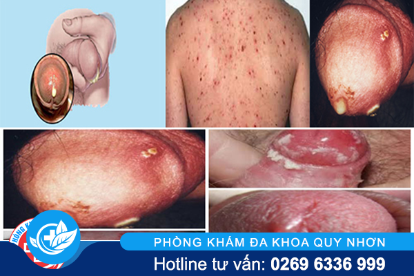 trieu-chung-benh-lau-o-nam-gioi-la-gi