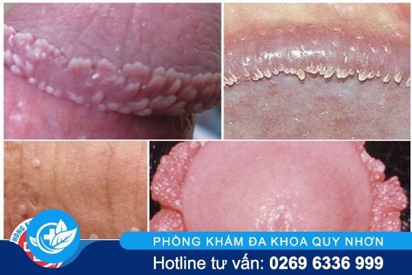 Nguyên nhân b?nh sùi mào gà ? Nam gi?i