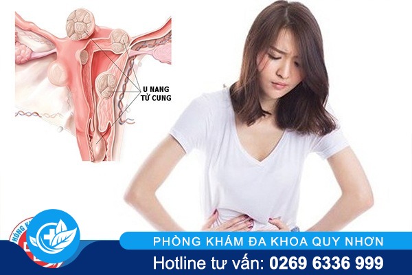 U nang tử cung là gì? – Nguyên nhân, cách hỗ trợ điều trị