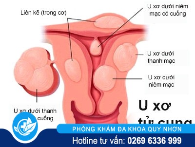 Hỗ trợ điều trị u xơ tử cung như thế nào hiệu quả