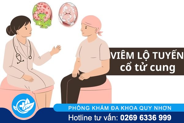 Cách nhận biết viêm lộ tuyến cổ tử cung ở nữ giới