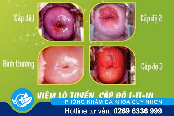 cach-nhan-biet-viem-lo-tuyen-co-tu-cung-o-nu-gioi-02