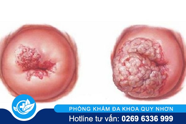 cach-nhan-biet-viem-lo-tuyen-co-tu-cung-o-nu-gioi-03