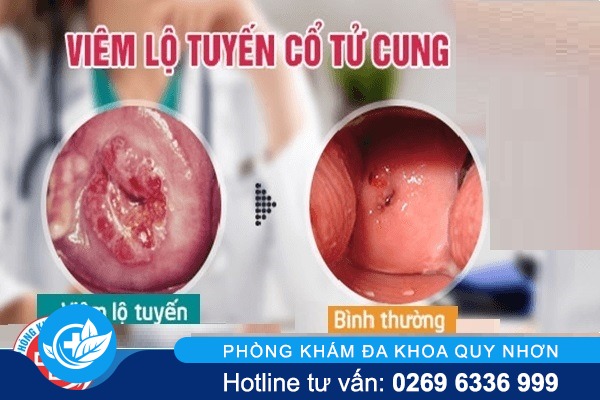 viem-lo-tuyen-co-tu-cung-nguy-hiem