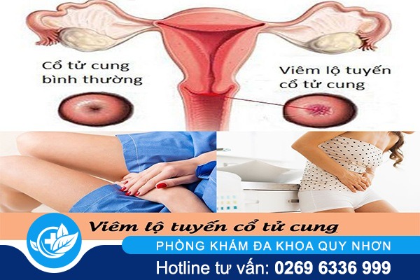 viem-lo-tuyen-co-tu-cung-nguy-hiem