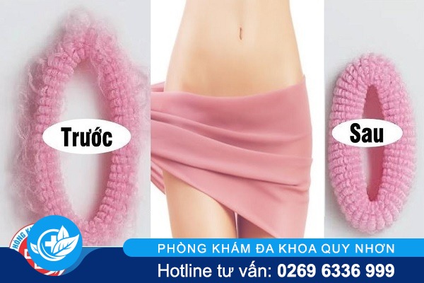 Âm đạo như thế nào là đẹp?