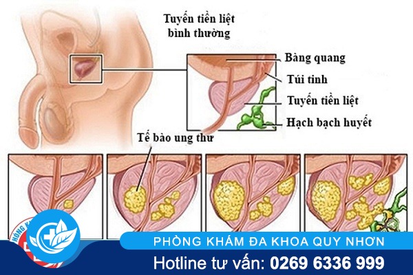 viem-tuyen-tien-liet