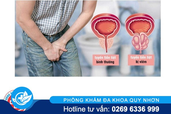 Triệu chứng của bệnh viêm tuyến tiền liệt ở nam giới