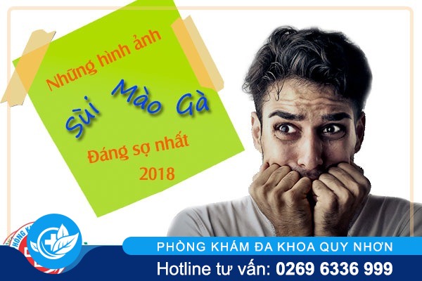 Những hình ảnh sùi mào gà đáng sợ