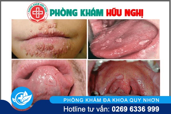 dieu-tri-sui-mao-ga-tai-da-nang