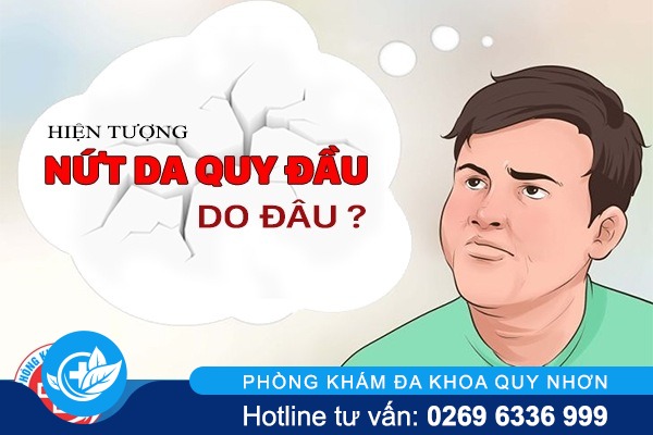 Nứt da quy đầu do đâu ? Dấu hiệu và phương pháp hỗ trợ điều trị