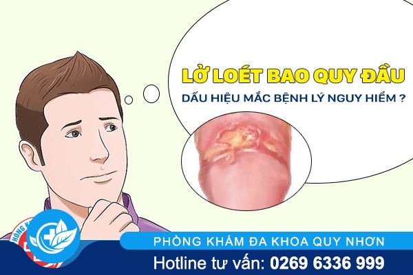 loét quy đầu