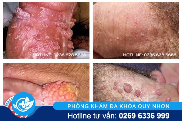 dieu-tri-sui-mao-ga-tot-nhat-da-nang